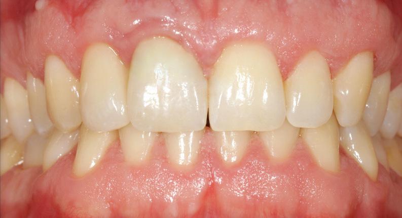 Nachher: Implantatkrone und Zahnfleischrekonstruktion mit Gingivaplastik