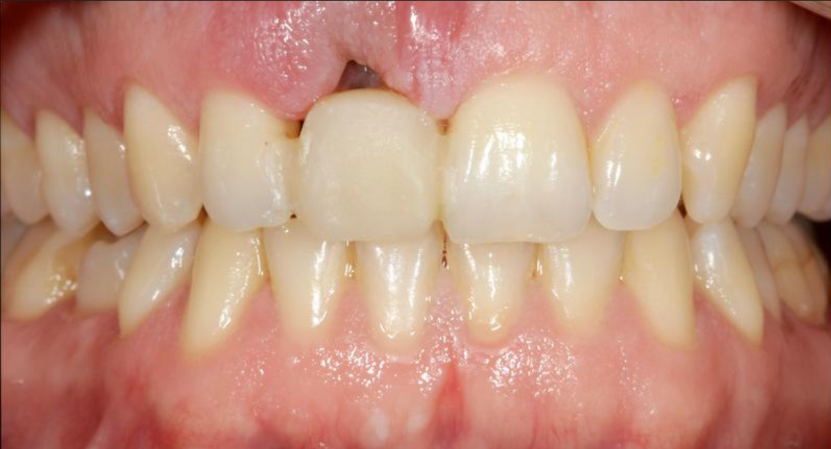 Vorher: Zahnfleischdefekt nach Zahnverlust